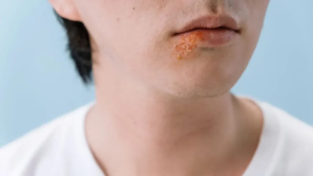 Lábio inferior com ferida de herpes labial
